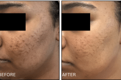 LB Microneedling Acne Scars - Patient8