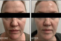 LB Microneedling Acne Scars - Patient9a