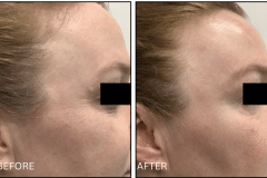 LB Microneedling Acne Scars - Patient9b
