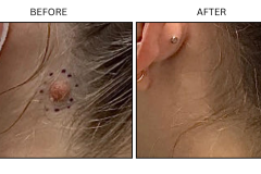 LB Surgical Mole Removal - Patient1