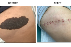 LB Surgical Mole Removal - Patient2