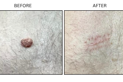 LB Surgical Mole Removal - Patient3