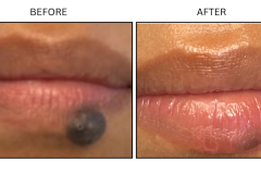 LB Surgical Mole Removal - Patient4