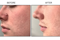 LB Surgical Mole Removal - Patient5