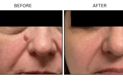 LB Surgical Mole Removal - Patient6