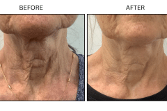LB Lasers Morpheus8 - Patient11