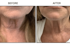 LB Lasers Morpheus8 - Patient23