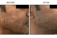 LB Lasers Morpheus8 - Patient24