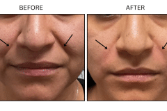 LB Fillers Nasolabial Folds Smile Lines - Patient10