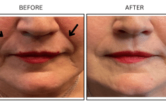 LB Fillers Nasolabial Folds Smile Lines - Patient8