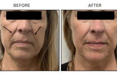 LB Fillers Nasolabial Folds Smile Lines - Patient9