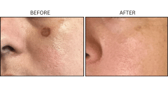LB Lasers Picosecond - Patient1