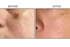 LB Lasers Picosecond - Patient1