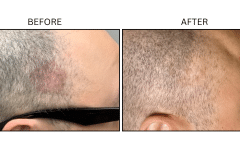 LB Lasers Picosecond - Patient2