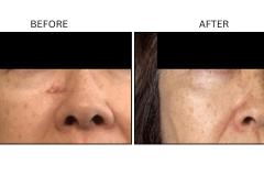 LB Lasers Picosecond - Patient3