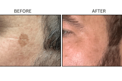 LB Lasers Picosecond - Patient4