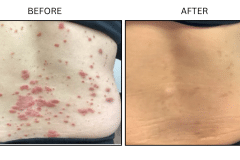 LB Medical Psoriasis - Patient1