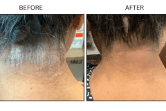 LB Medical Psoriasis - Patient2