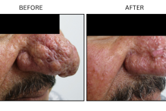 LB Surgical Rhinophyma - Patient1a