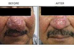 LB Surgical Rhinophyma - Patient1b