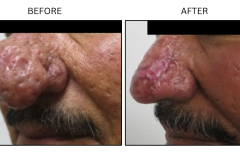 LB Surgical Rhinophyma - Patient1c