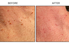 LB Surgical Skin Tags - Patient1