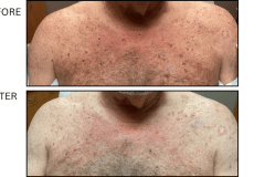 LB Medical Sun Freckles Spots - Patient4