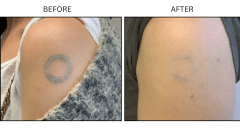 LB Lasers Tattoo Removal - Patient1