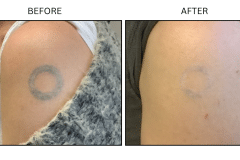 LB Lasers Tattoo Removal - Patient1
