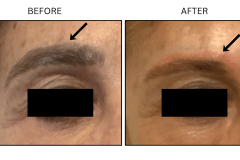 LB Lasers Tattoo Removal - Patient2
