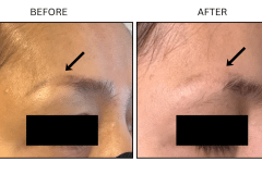 LB Lasers Tattoo Removal - Patient3