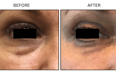 LB Fillers Under Eyes - Patient10
