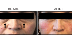 LB Fillers Under Eyes - Patient11