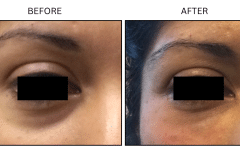 LB Fillers Under Eyes - Patient12