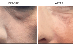 LB Fillers Under Eyes - Patient13