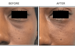 LB Fillers Under Eyes - Patient14