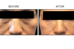 LB Fillers Under Eyes - Patient15