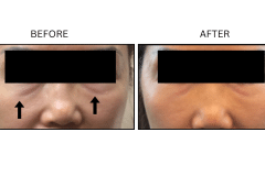 LB Fillers Under Eyes - Patient16