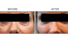 LB Fillers Under Eyes - Patient17