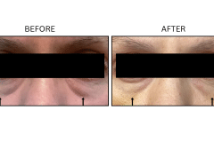 LB Fillers Under Eyes - Patient18