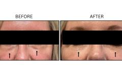 LB Fillers Under Eyes - Patient19