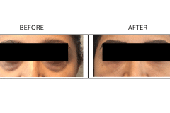 LB Fillers Under Eyes - Patient9