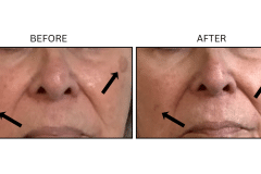 LB Lasers Vbeam - Patient3