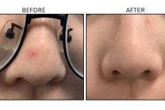 LB Lasers Vbeam - Patient4