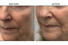 LB Lasers Vbeam - Patient5