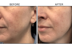 LB Lasers Vbeam - Patient6a
