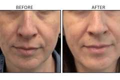 LB Lasers Vbeam - Patient6b