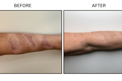 LB Lasers Vbeam - Patient7