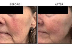 LB Lasers Vbeam - Patient7