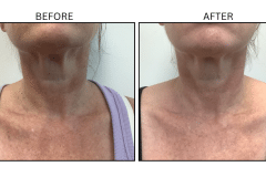LB Lasers Vbeam - Patient8